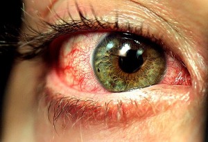 B2 Deficiency